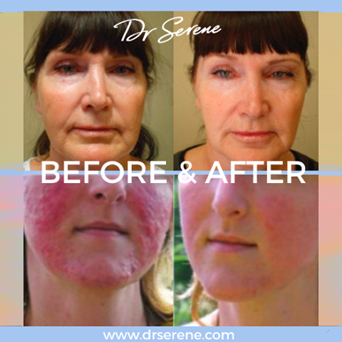 Incredible results after treatments with Dr Serene. 